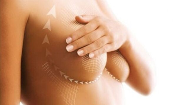 lifting sutures for breast augmentation
