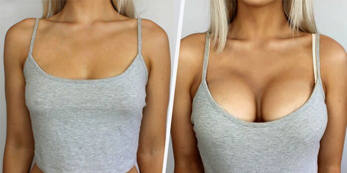 before and after breast augmentation surgery