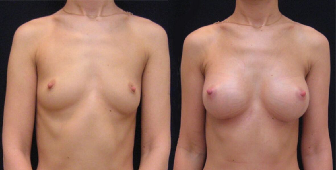breasts before and after endoscopic augmentation