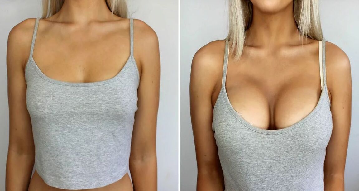 Breast Increase 3 Sizes