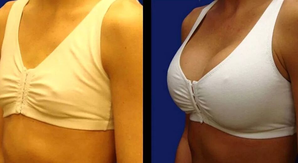 Photo of the chest before and after surgery