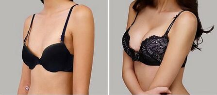 Photo before and after breast enlargement