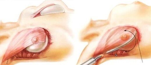 How to perform the operation of increasing breast enhancement