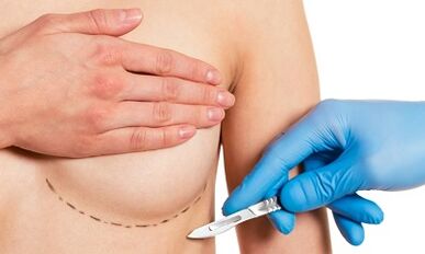 Submarine access to the extension of breast with implants