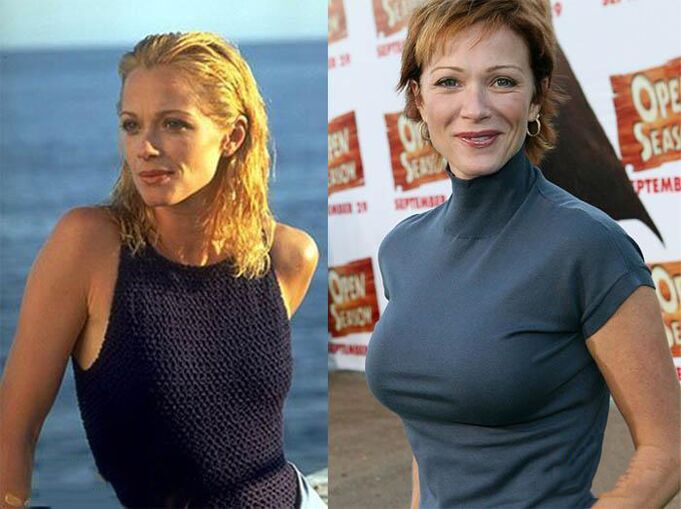 before and after mammoplastics