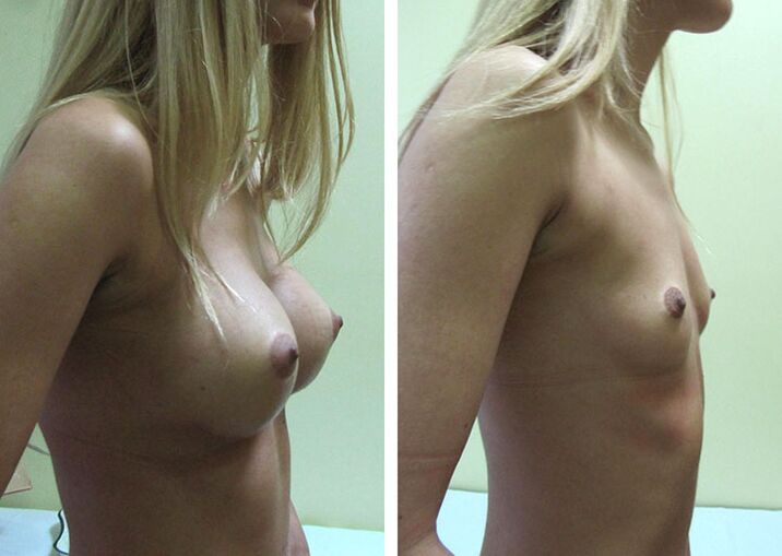 The result of breast augmentation with implants