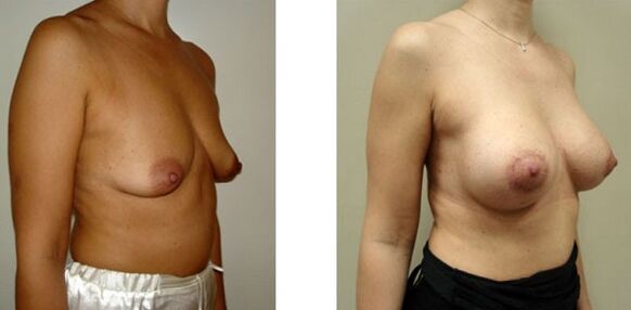 breasts before and after augmentation