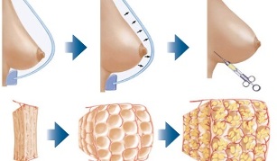 how to perform the procedure of breast augmentation with fat