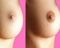 before and after nipple augmentation