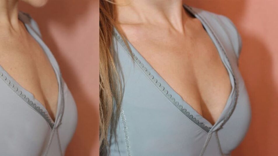 breast enlargement products before and after
