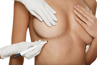 Marking with a marker before breast augmentation surgery
